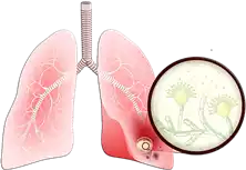 نزلة شعبية (التهاب الشعب الهوائية) Bronchitis