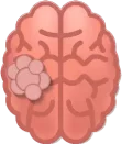 ورم في المخ Brain tumor