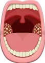 التهاب اللوزتين Tonsillitis